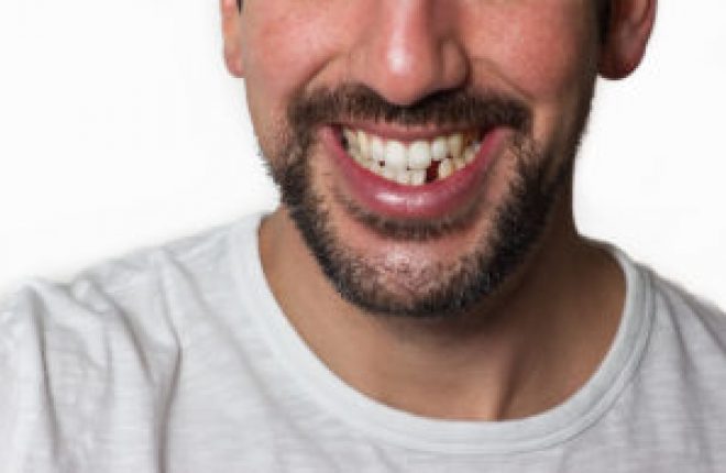 How Do We Treat Missing Teeth?