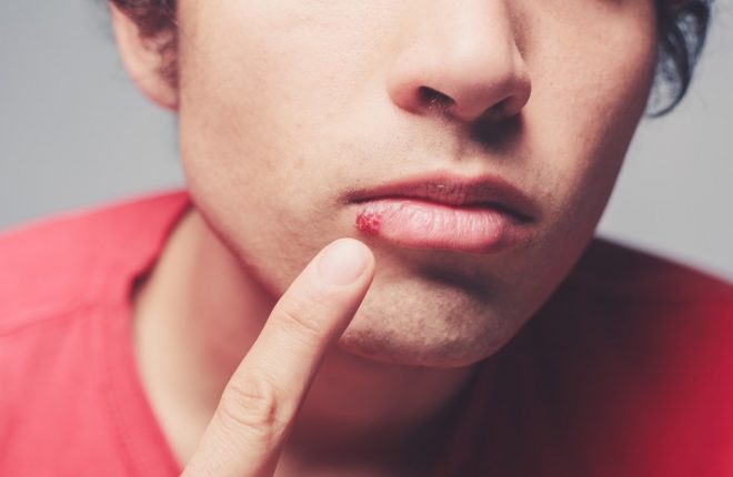 What to Expect from Your Cold Sore