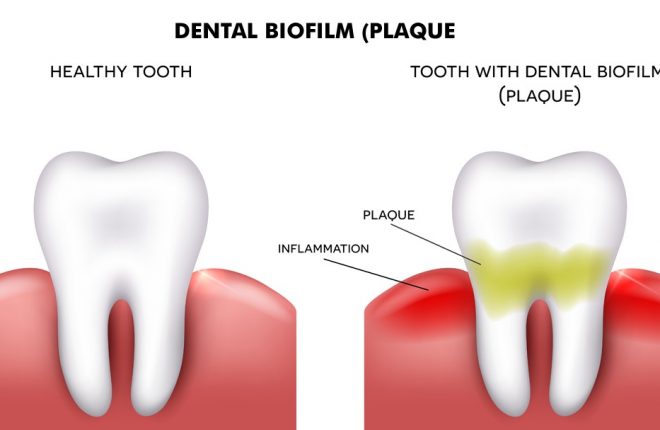 What is dental plaque?
