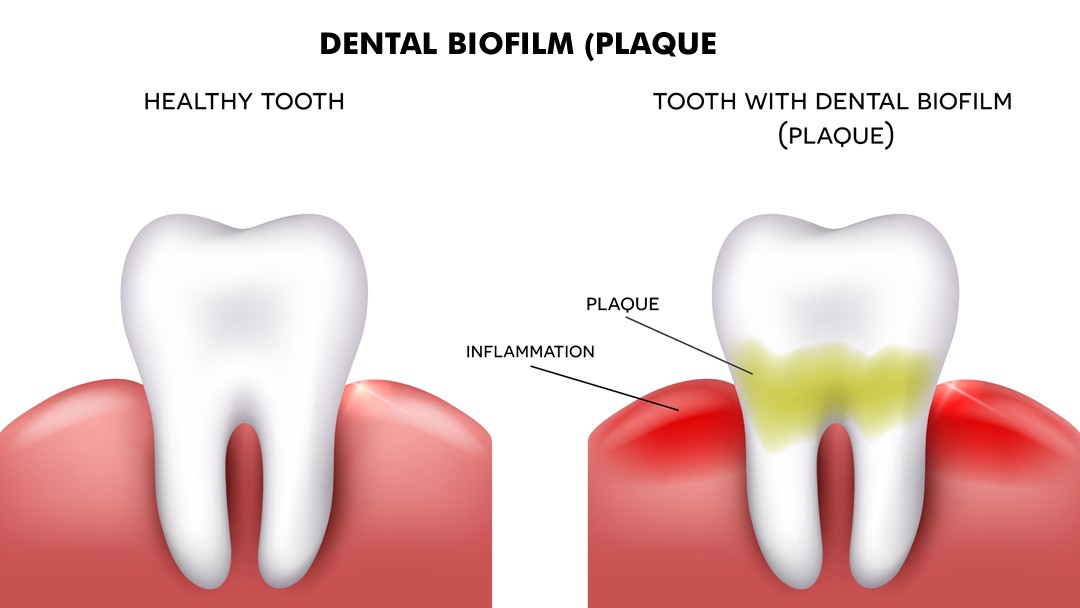 What is dental plaque?
