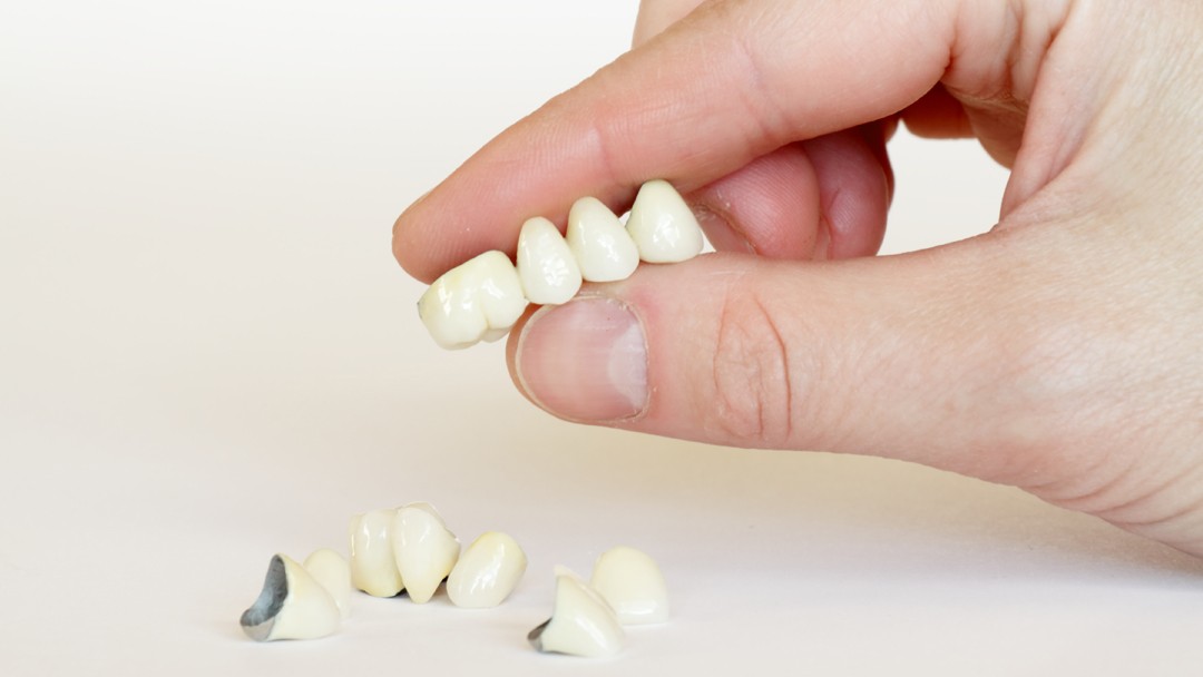 What Exactly Are Dental Crowns and Tooth Bridges?