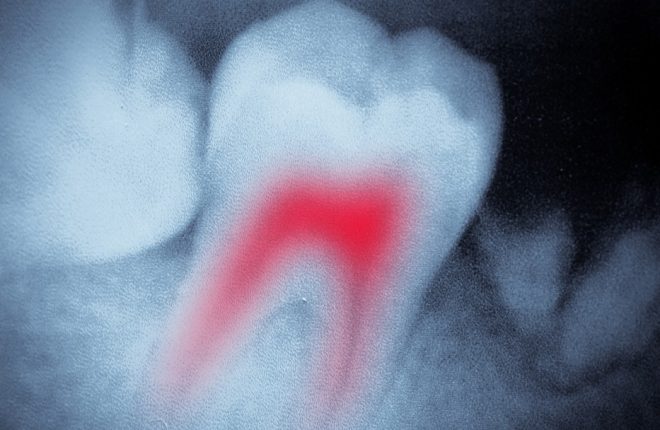 What Is a Root Canal? The Basics