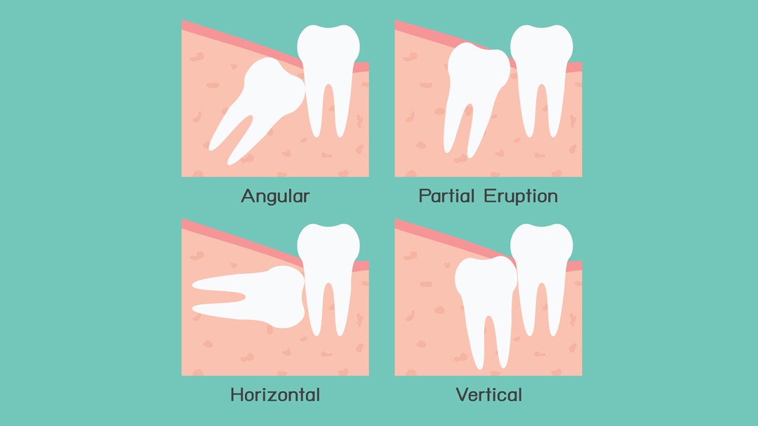 Know the Warning Signs of Impacted Wisdom Teeth