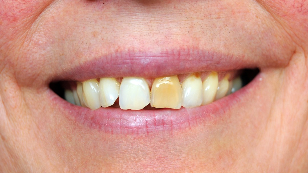 Does Discoloured Teeth Mean They’re Unhealthy?
