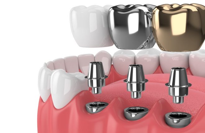 Improve Your Life with Dental Implants