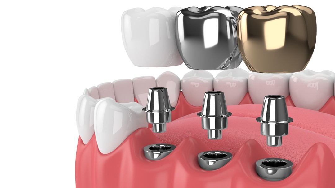 Improve Your Life with Dental Implants