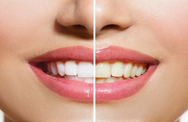 What You Need to Know About Home Teeth Whitening