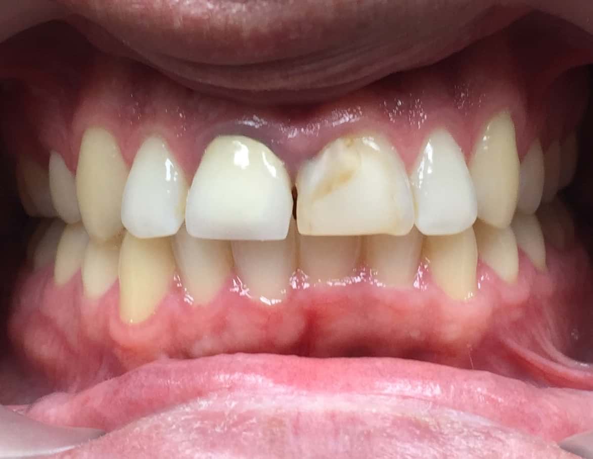 5 Advantages of Same-Day Crowns