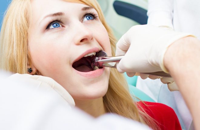 What You Should Know About Wisdom Teeth Removal