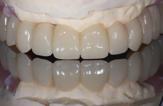 Can I Replace All My Teeth with Full Arch Implants?