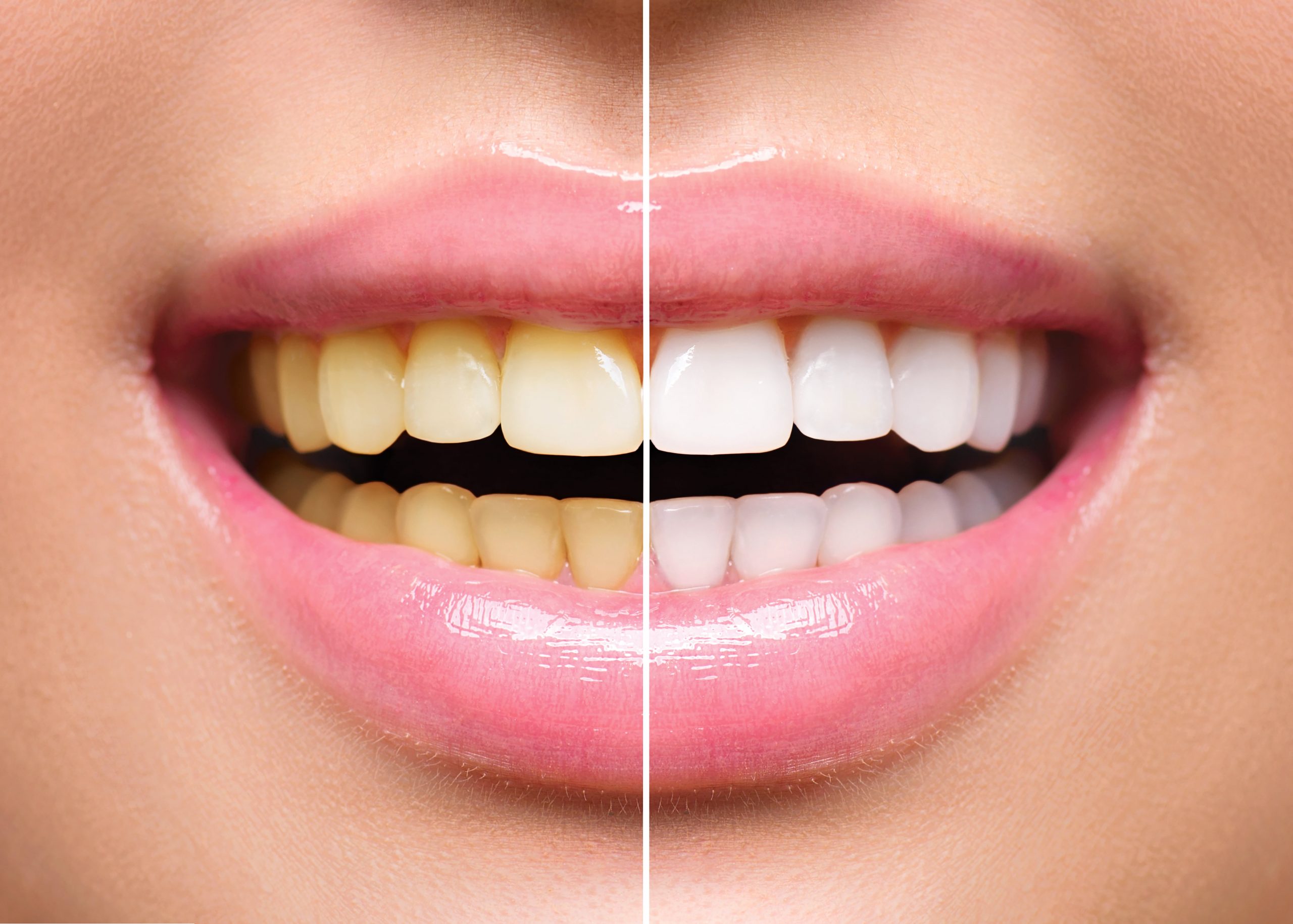 How Often is Teeth Whitening Recommended & Other FAQs