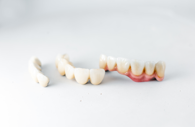 Dental Crowns vs Veneers: Understanding the Differences